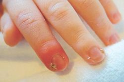 Chín mé gây biến chứng gì?