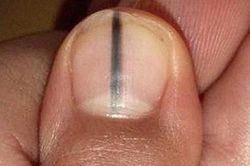 3 bộ phận bị thâm đen chứng tỏ gan bạn đang ở giai đoạn nặng