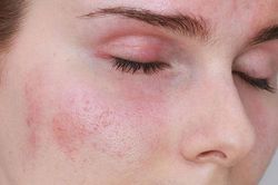 Da nổi mẩn đỏ chị em cần dùng ngay cách này