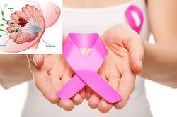 Sáng kiến toàn cầu mới về ung thư vú: Cải thiện khả năng sống sót cho người bệnh
