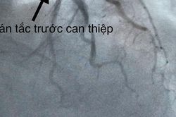 Một người dân ngưng tim, ngưng thở được cứu sống