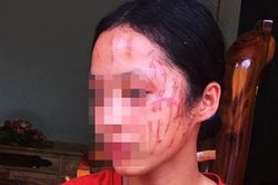 Bị cào rách mặt vì bênh em gái