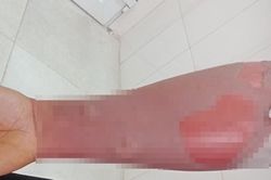 Người đàn ông bị loét da sau khi tắm bằng lá cây