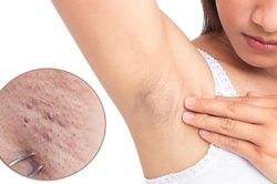 Không cần dùng nhíp lông nách vẫn sạch bong