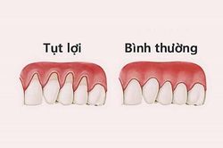 Hậu quả đáng ngại khi bị tụt lợi