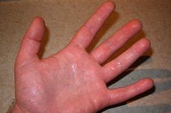 Chữa khỏi bệnh mồ hôi tay, nách cho nam thanh niên