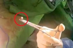Cứu sống bệnh nhân bị đạn bắn thủng bụng nguy kịch