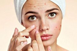 7 cách đơn giản giúp bạn ngăn ngừa mụn trên mặt