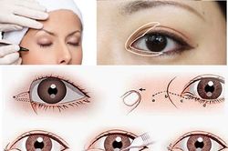 Buồn vì mắt híp liền đi mở góc mắt, không ngờ 'mắt bồ câu con bay con đậu'