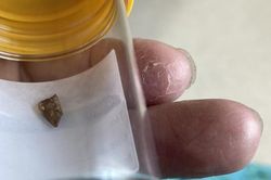 Khám sức khỏe định kỳ phát hiện xương gà 'mắc kẹt' trong ruột mà không biết