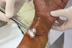 Người đàn ông bị máy cưa gỗ cắt vào cẳng tay
