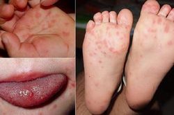 6 việc cần làm ngay để phòng bệnh tay chân miệng cho trẻ