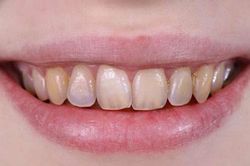 Ăn uống sai cách là nguyên nhân gây hỏng răng