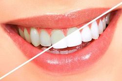 Cao răng dày tới mấy cũng bật ra từng mảng lớn, hết hẳn hôi miệng nhờ thứ 'bỏ đi' này