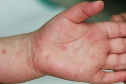 Một trường hợp tử vong do mắc tay chân miệng