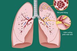 Tìm ra căn nguyên gây bệnh viêm đường hô hấp mạn tính