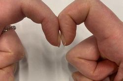 6 dấu hiệu cảnh báo ung thư phổi nhiều người không biết