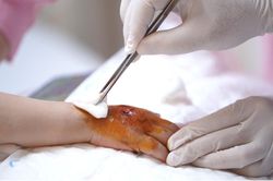 Bị tủ đè vào tay gãy xương, bé 4 tuổi phải nhập viện vì hoại tử da do đắp lá
