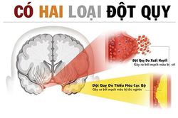 Cấp cứu người đột quỵ: Sự sống tính bằng giây