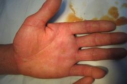 Cách nhận biết nhiễm độc thạch tín