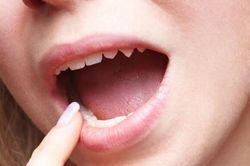 Xử trí khô miệng do dùng thuốc