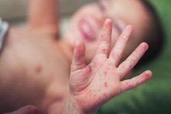 Số ca mắc tay chân miệng vào Bệnh viện Nhi đã tăng gấp 6 lần năm trước