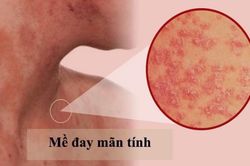 Mỹ cho phép tự tiêm tại nhà thuốc trị dị ứng