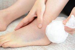 Điều tối kỵ khi bị bong gân