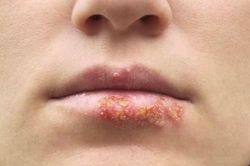 Tỷ lệ người mắc bệnh lây truyền qua đường tình dục tại Mỹ cao kỷ lục