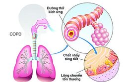 Ứng phó với cơn cấp bệnh phổi tắc nghẽn mạn tính
