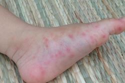 Trẻ bị nổi mụn nước trên da, chuyên gia khuyến cáo gì?
