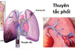 Đối tượng dễ mắc thuyên tắc phổi