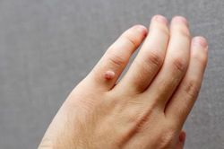 Top 6 cách đánh bay mụn cóc đơn giản, dễ làm tại nhà