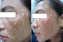 Da loang lổ chỉ vì làm đẹp với lá trầu không