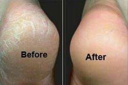 2 cách trị nứt gót chân ai cũng làm được