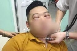 Nguy kịch vì 1 củ hành, cách xử lý sốc phản vệ theo Bộ Y tế
