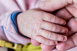 Chăm sóc trẻ bị khô da đúng cách