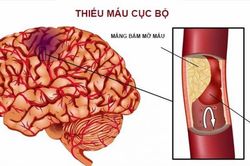 Cách phát hiện 'kẻ thù nguy hiểm'- Cục máu đông