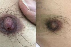Bị bệnh giang mai vú hiếm gặp sau khi quan hệ đồng tính