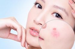 Trị mụn trứng cá hiệu quả cho những nàng lười
