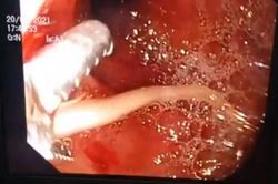 Bé trai 5 tuổi viêm tụy cấp do bị giun chui vào ống tụy
