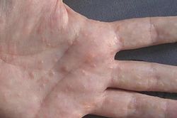 Có phải bệnh tổ đỉa?