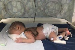 Người lớn tự lấy kim chích mụn, bé 15 ngày tuổi nhiễm trùng nặng