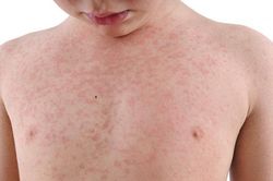 Chế độ ăn uống khi bị Rubella: Người bệnh cần lưu ý gì?