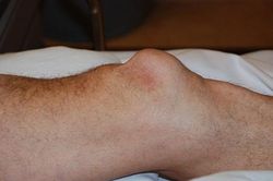 U nang bao hoạt dịch khớp gối: Nhận biết sớm, chữa trị nhanh