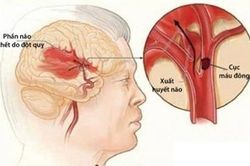 Chấn thương sọ não có thể làm tăng nguy cơ đột quỵ