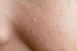 2 cách trị mụn đầu trắng bạn chưa biết