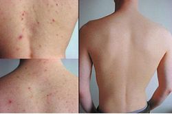 4 điều cần ghi nhớ để có thể hết mụn ở lưng
