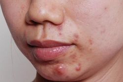 Chế độ dinh dưỡng cho người bị mụn trứng cá