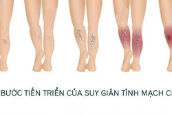 Bài tập cho người suy giãn tĩnh mạch chân